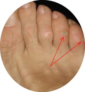 Corn On Foot Find Out How To Fix A Corn On Your Foot