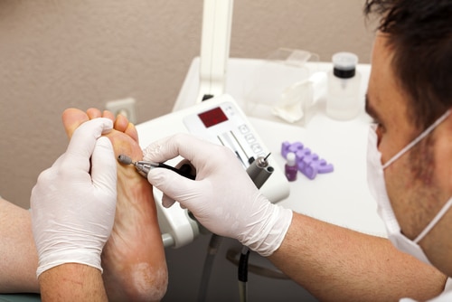 Fungal Nail Laser Treatment