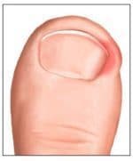 infected toe