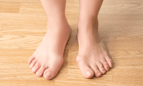 Image of painful bunions by ModPod Podiatry